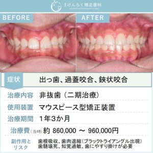 16歳男子：上顎前突、過蓋咬合および両側第二大臼歯の鋏状咬合をマウスピース矯正で非抜歯で治療したケース
