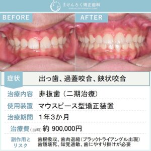 16歳男子：上顎前突、過蓋咬合および両側第二大臼歯の鋏状咬合をマウスピース矯正で非抜歯で治療したケース