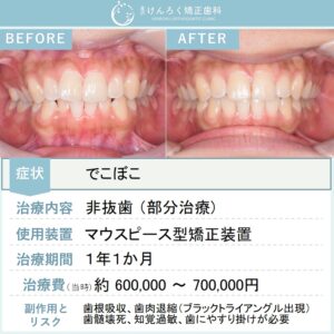 21歳女性：ワイヤー矯正とマウスピース矯正（インビザライン）のコンビネーションにて非抜歯で治したケース