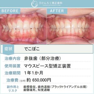 21歳女性：ワイヤー矯正とマウスピース矯正（インビザライン）のコンビネーションにて非抜歯で治したケース