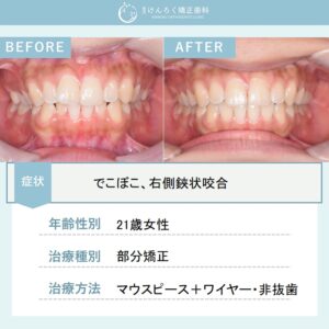 前歯と奥歯のでこぼこをワイヤー矯正とマウスピース矯正(インビザライン)のコンビネーションにて非抜歯で治したケース