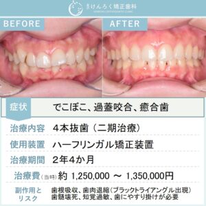 23歳女性：ハーフリンガル矯正装置で抜歯により叢生を改善したケース