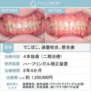 23歳女性：ハーフリンガル矯正装置で抜歯により叢生を改善したケース