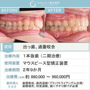 14歳女子：前歯のでこぼことかみ合わせのずれをマウスピース型矯正装置（インビザライン）で治したケース