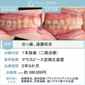 14歳女子：前歯のでこぼことかみ合わせのずれをマウスピース型矯正装置（インビザライン）で治したケース