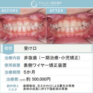 ８歳女子：下顎前突（反対咬合）をワイヤー矯正で治したケース