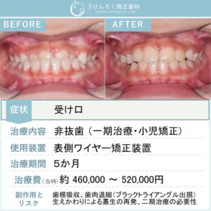 ８歳女子：下顎前突（反対咬合）をワイヤー矯正で治したケース