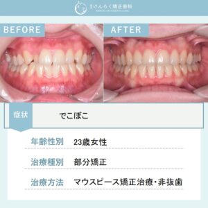 前歯のでこぼこをマウスピース矯正（インビザライン）で非抜歯で治したケース