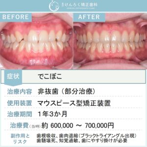 23歳女性：前歯のでこぼこをマウスピース矯正（インビザライン）で非抜歯で治したケース