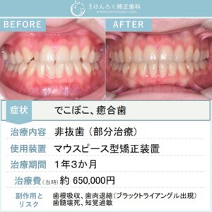23歳女性：前歯のでこぼこをマウスピース矯正（インビザライン）で非抜歯で治したケース