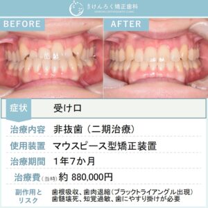 29歳女性：マウスピース矯正（インビザライン）にて受け口を非抜歯で治したケース