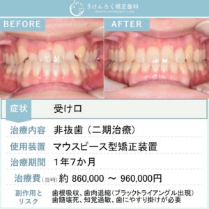 29歳女性：マウスピース矯正（インビザライン）にて受け口を非抜歯で治したケース