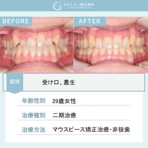 マウスピース矯正(インビザライン)にて受け口を非抜歯で治したケース