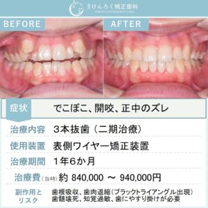 20歳女性：正中のズレを伴う叢生と開咬を、正中を合わせるために第一小臼歯を３本抜歯して１年半という短期間で治したケース