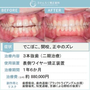 20歳女性：正中のズレを伴う叢生と開咬を、正中を合わせるために第一小臼歯を３本抜歯して１年半という短期間で治したケース