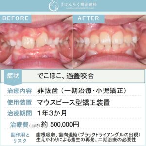 ８歳女子：前歯のでこぼことかみ合わせの深さを小児のマウスピース矯正で治したケース