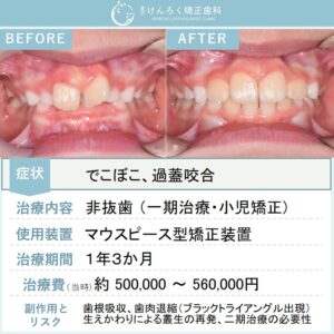 ８歳女子：前歯のでこぼことかみ合わせの深さを小児のマウスピース矯正で治したケース