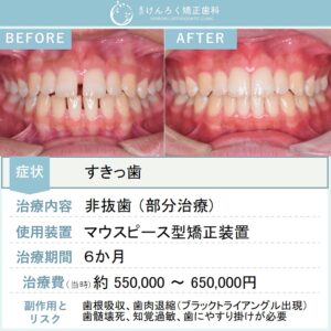 15歳男子：前歯の隙間をマウスピース矯正装置（インビザライン）で治したケース