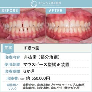 15歳男子：前歯の隙間をマウスピース矯正装置（インビザライン）で治したケース