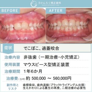10歳男子：小児矯正で前歯のでこぼこをマウスピース矯正装置（インビザライン）で治したケース