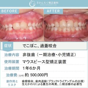 10歳男子：小児矯正で前歯のでこぼこをマウスピース矯正装置（インビザライン）で治したケース
