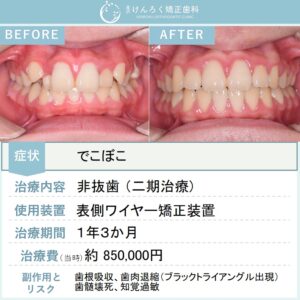 12歳男子：でこぼことかみ合わせのズレを患者さまの成長を利用して当院で非抜歯で治したケース