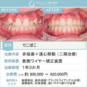 12歳男子：でこぼことかみ合わせのズレを患者さまの成長を利用して当院で非抜歯で治したケース