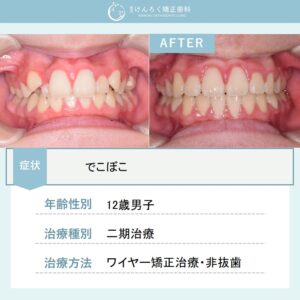 でこぼことかみ合わせのズレを、患者さまの成長を利用して当院で非抜歯で治したケース