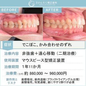 24歳女性：マウスピース矯正（インビザライン）にて上顎大臼歯の遠心移動を行い、叢生を非抜歯で治したケース