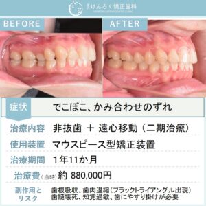 24歳女性：マウスピース矯正（インビザライン）にて上顎大臼歯の遠心移動を行い、叢生を非抜歯で治したケース