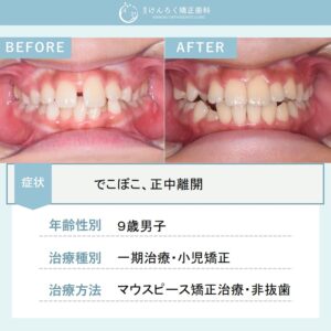下顎の前歯のでこぼこをお子さまのマウスピース矯正で治したケース