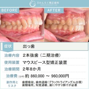 26歳女性：マウスピース矯正（インビザライン）にて上顎前突を小臼歯２本抜歯で治したケース