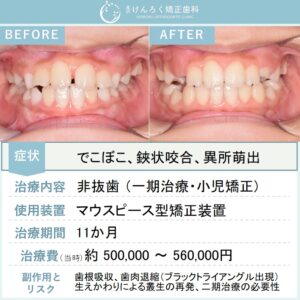 ８歳女子：永久歯が生えるスペースが全然足りなかったお子さまをマウスピース矯正で治したケース
