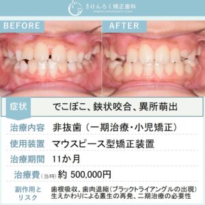 ８歳女子：永久歯が生えるスペースが全然足りなかったお子さまをマウスピース矯正で治したケース