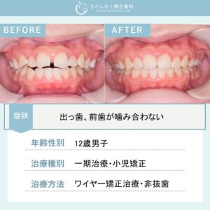 他院で４本抜歯と説明を受けたけど抜きたくないという希望を叶えたケース