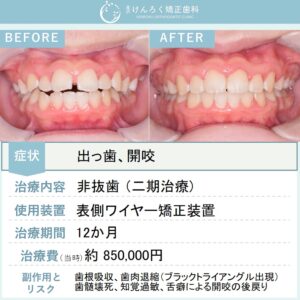 12歳男子：他院で４本抜歯と説明を受けたけど抜きたくないという希望を叶えたケース