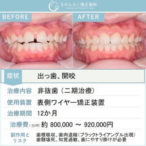 12歳男子：他院で４本抜歯と説明を受けたけど抜きたくないという希望を叶えたケース