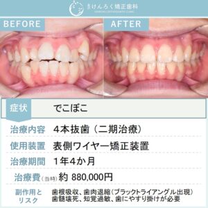 12歳女子：でこぼこを上下左右の第一小臼歯を４本抜歯して１年４か月という短期間で治したケース