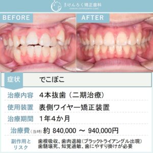 12歳女子：でこぼこを上下左右の第一小臼歯を４本抜歯して１年４か月という短期間で治したケース