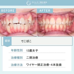 でこぼこを上下左右の第一小臼歯を４本抜歯して１年４か月という短期間で治したケース