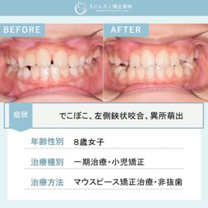 永久歯が生えるスペースが全然足りなかったお子さまをマウスピース矯正で治したケース
