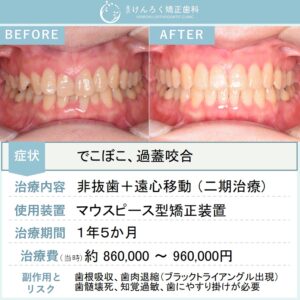 50歳女性：マウスピース矯正（インビザライン）にて叢生を非抜歯で治療したケース