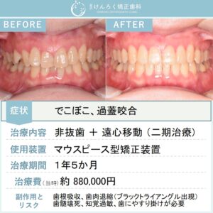50歳女性：マウスピース矯正（インビザライン）にて叢生を非抜歯で治療したケース