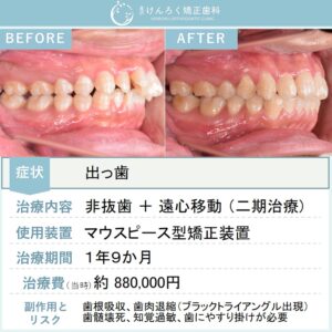 22歳男性：上顎前突と叢生を歯列全体の遠心移動を行い非抜歯で治したケース