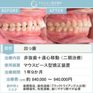 22歳男性：上顎前突と叢生を歯列全体の遠心移動を行い非抜歯で治したケース
