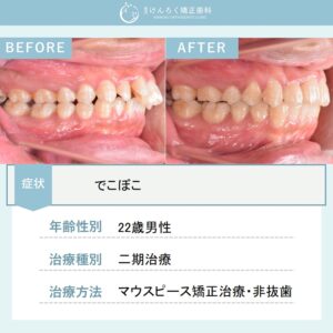 上顎前突と叢生を歯列全体の遠心移動を行い非抜歯で治したケース