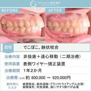 25歳女性：奥歯のズレとでこぼこを歯列の遠心移動を行い非抜歯で治したケース