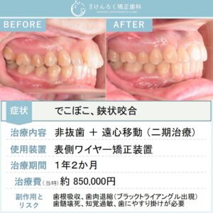25歳女性：奥歯のズレとでこぼこを歯列の遠心移動を行い非抜歯で治したケース