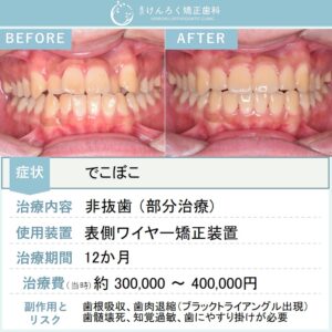 19歳男性：部分矯正で叢生を改善したケース