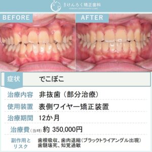 19歳男性：部分矯正で叢生を改善したケース